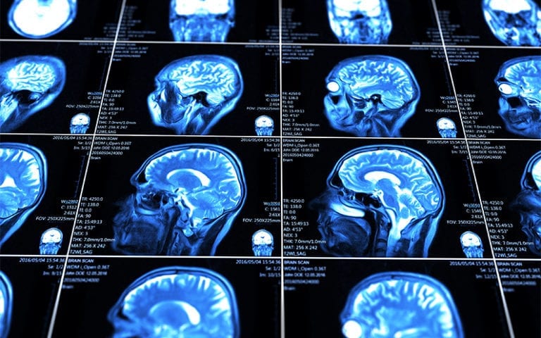 Multiple MRI brain scans are displayed in a grid, showing cross-sectional side views of the human head with medical data overlaid on each image.