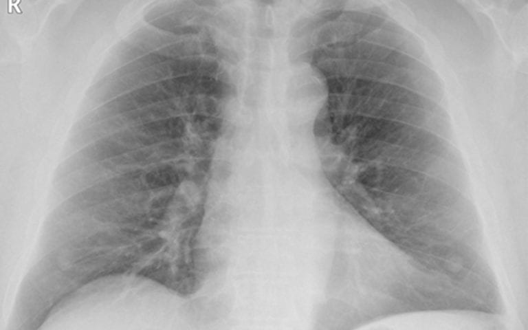 Chest X-ray showing the lungs, ribs, and heart area of an adult patient with no apparent abnormalities.